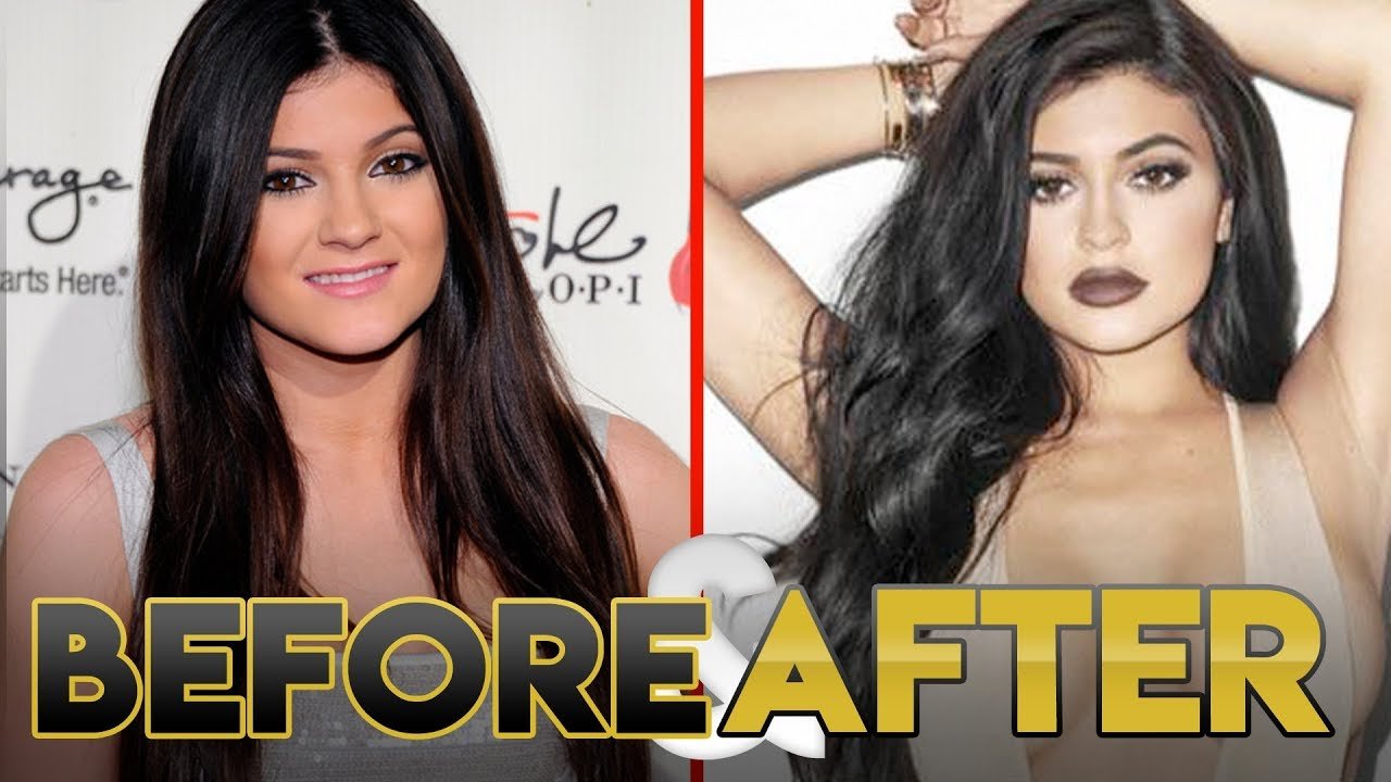 Kylie Jenner Before And After! Look What Happened!